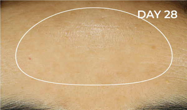 Reduction in forehead area after
