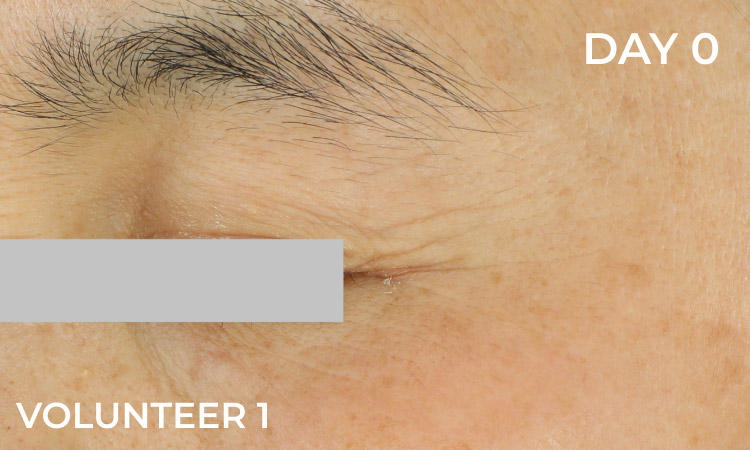 Reduction in eye wrinkles before