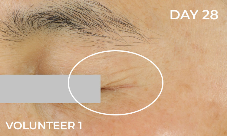 Reduction in eye wrinkles before