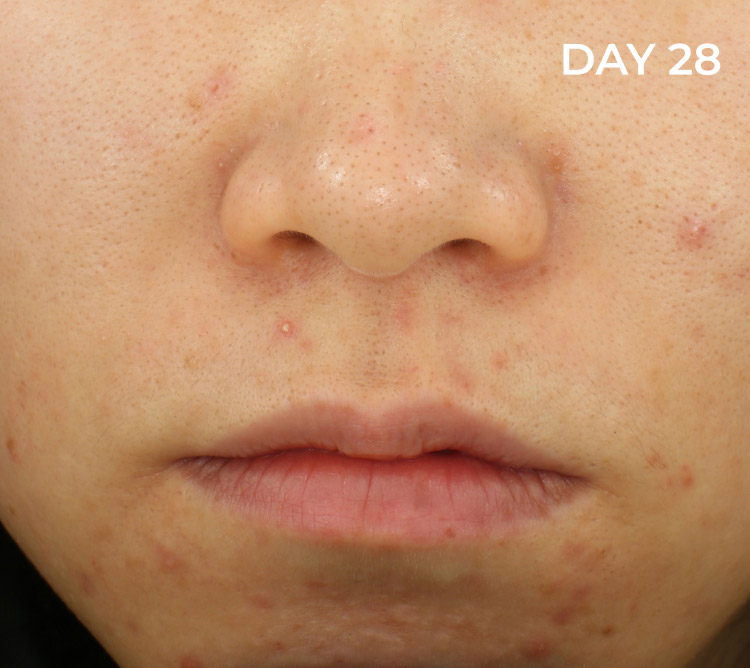 Reduction of blemishes after